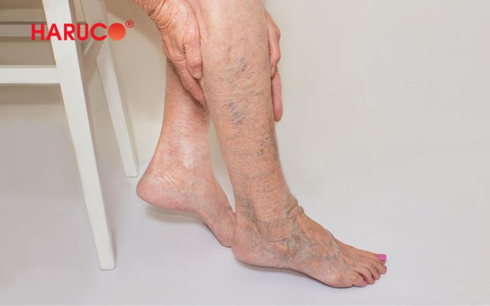 Người bị giãn tĩnh mạch chi dưới không nên ngâm chân