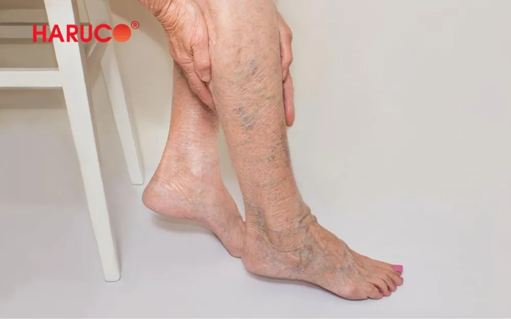 Người bị giãn tĩnh mạch chi dưới không nên ngâm chân