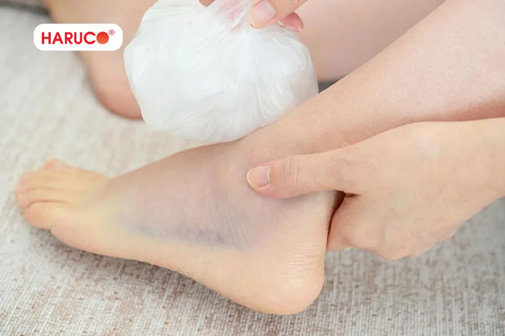Lưu ý trong chế độ ăn khi bị bong gân