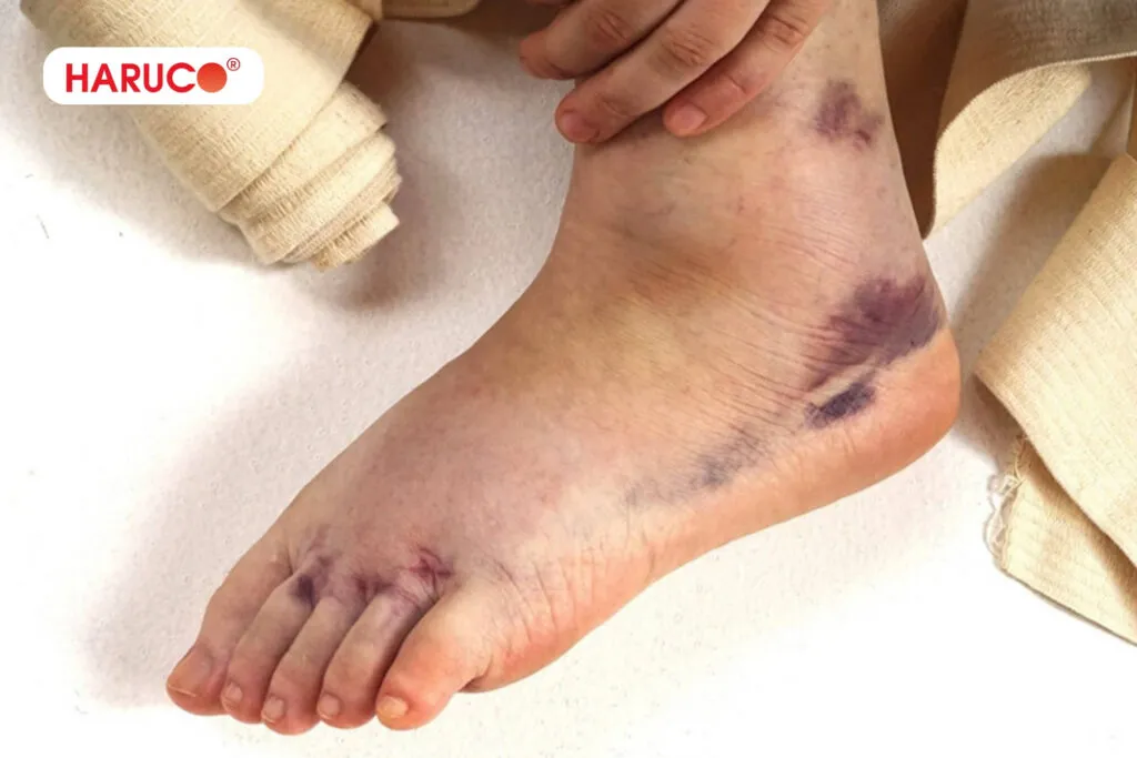 Bong gân bôi rượu thuốc được không?