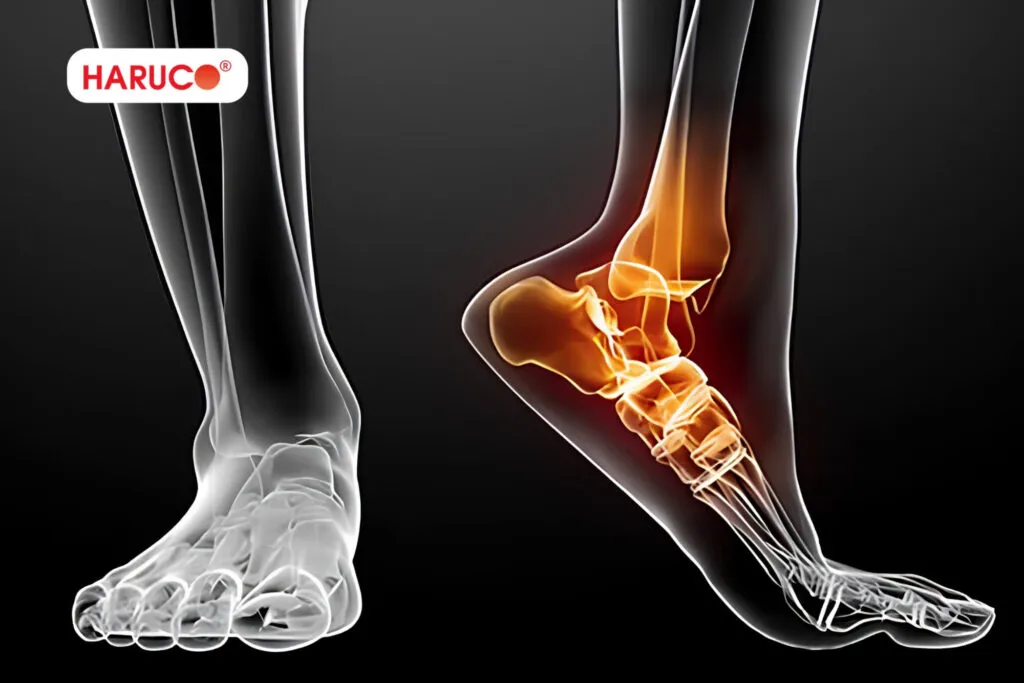 Bong gân và trật khớp khác gì nhau