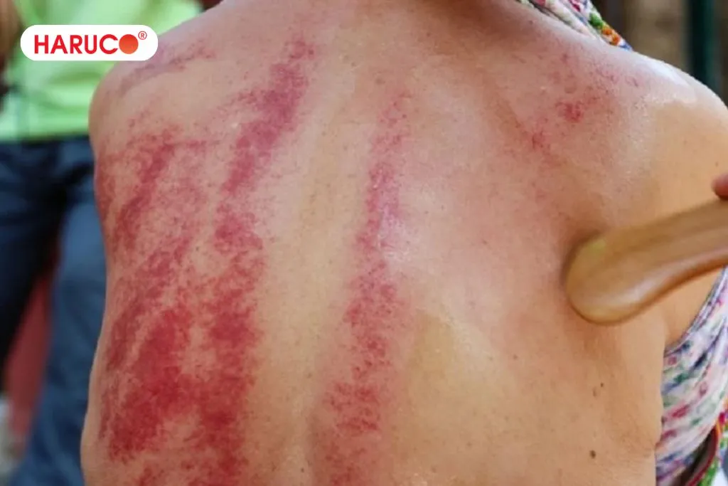 Cạo gió là gì?