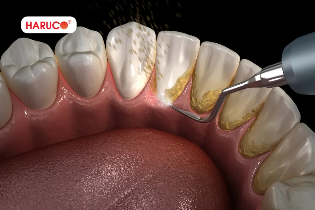 Những ai nên và không nên sử dụng máy lấy cao răng tại nhà?