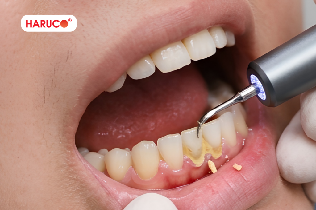 Ưu điểm khi dùng máy lấy cao răng tại nhà