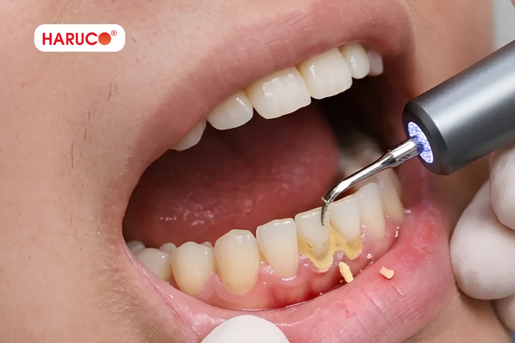 Ưu điểm khi dùng máy lấy cao răng tại nhà
