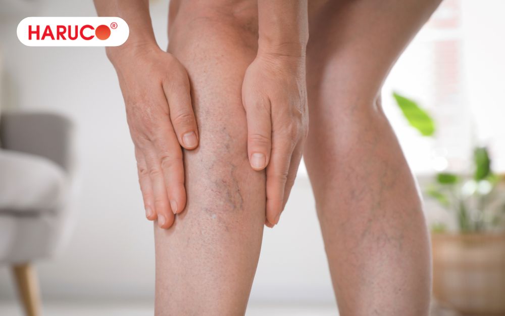 Người bị suy giãn tĩnh mạch chi dưới không nên ngâm chân