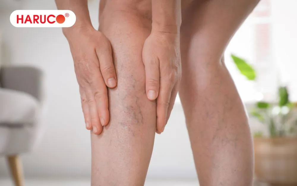 Người bị suy giãn tĩnh mạch chi dưới không nên ngâm chân
