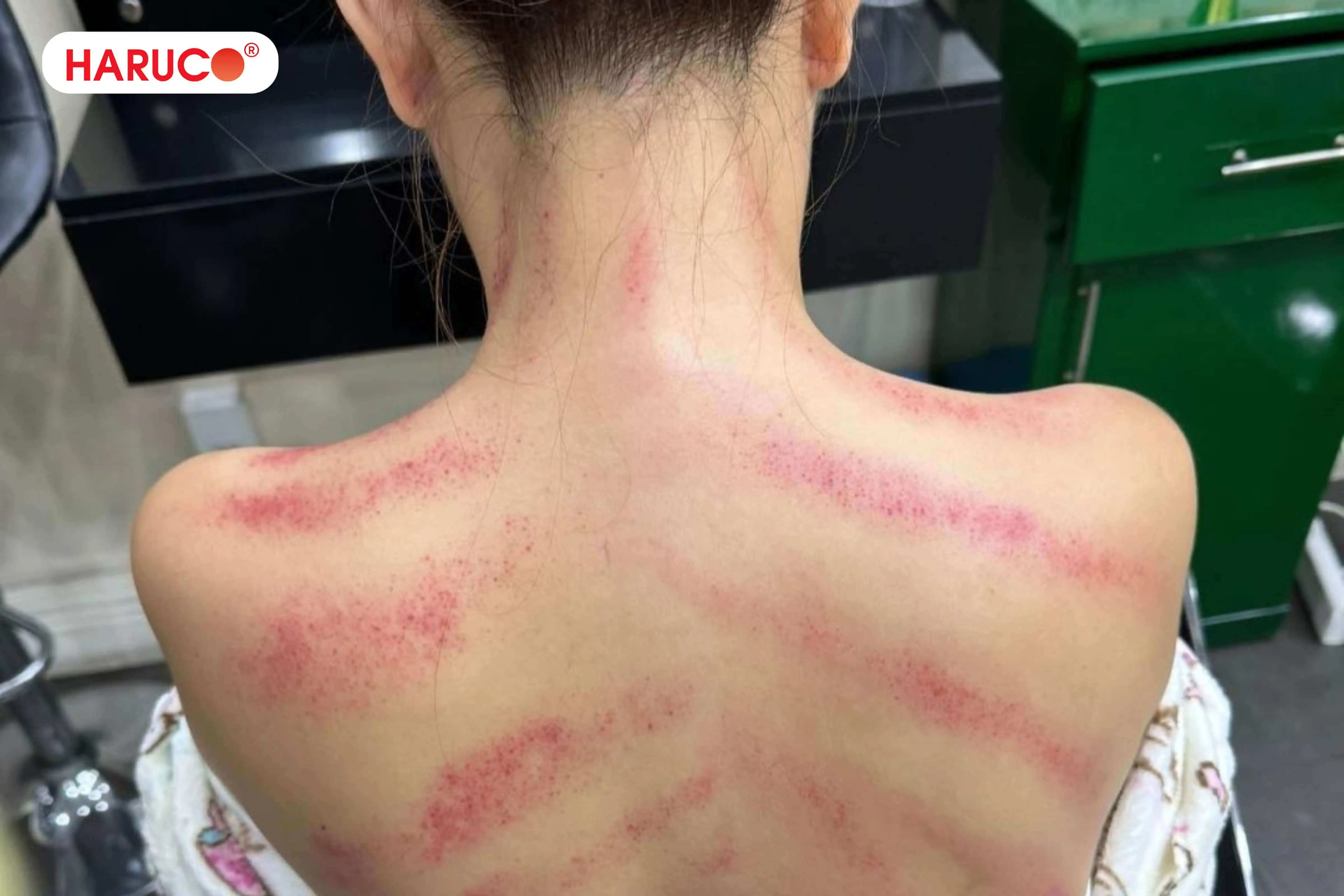 Những yếu tố quyết định vết cạo gió bao lâu thì hết