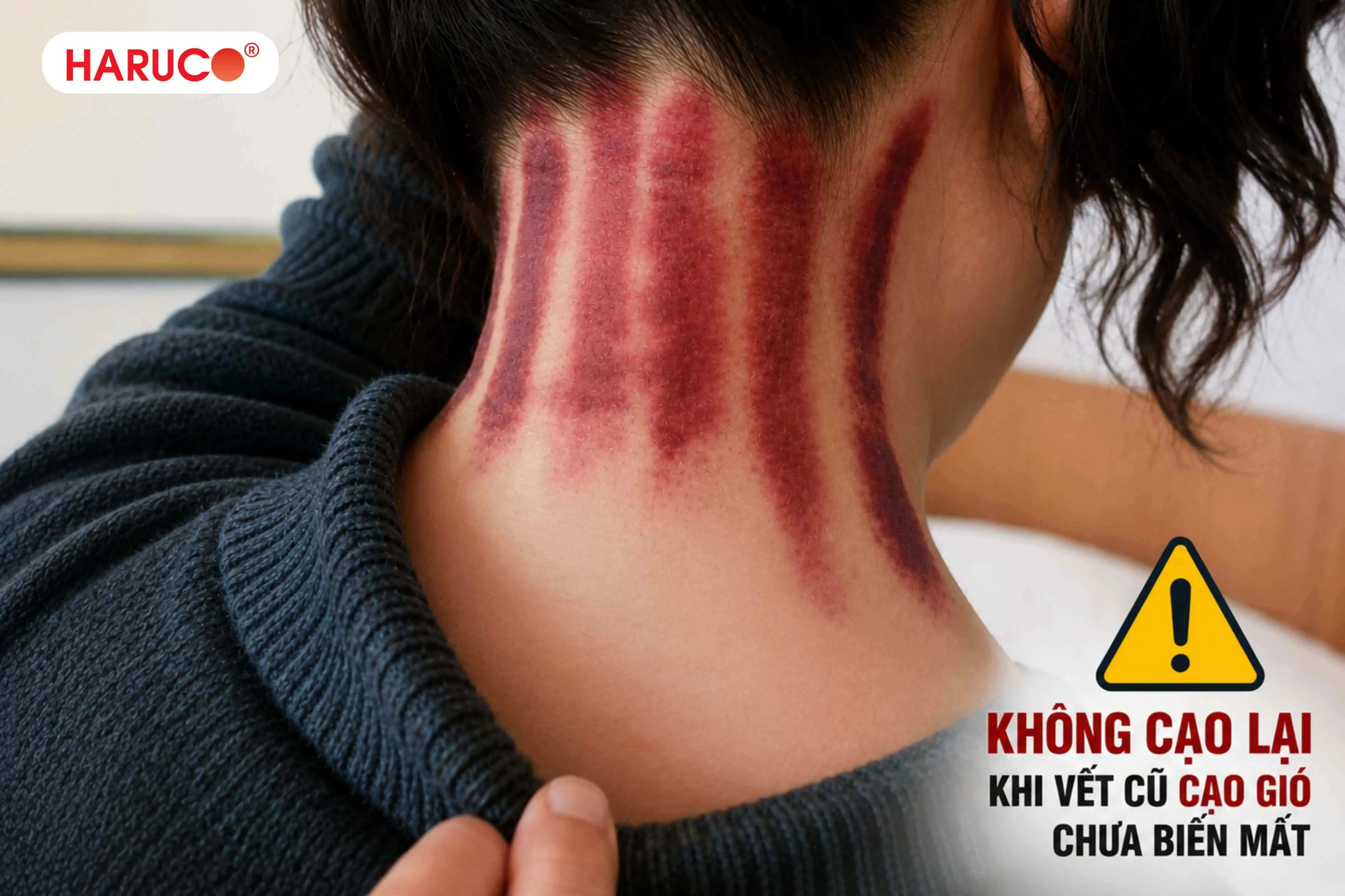 Cách để vết cạo gió nhanh tan hơn