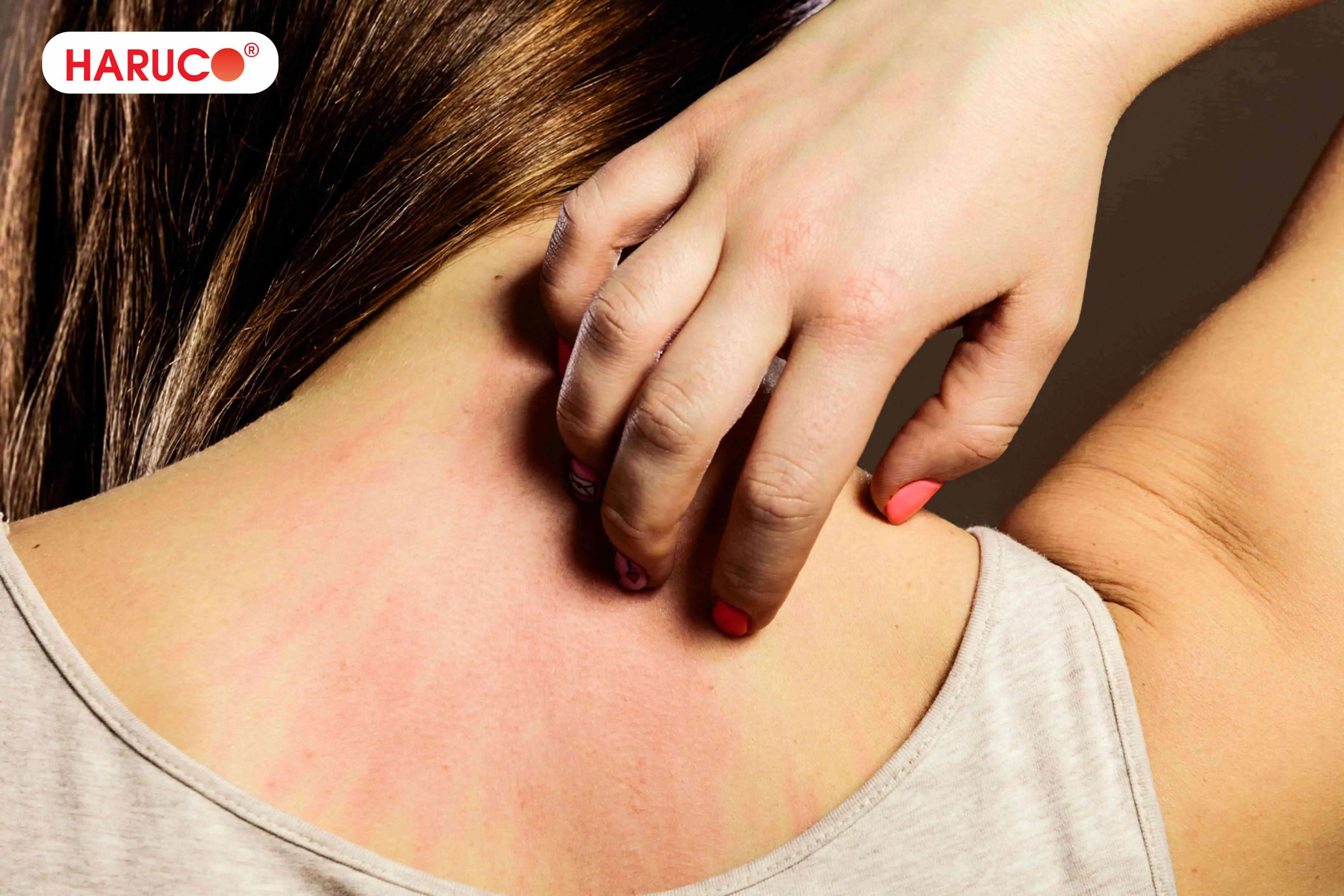 Những việc không nên làm sau khi cạo gió để tránh bị bầm
