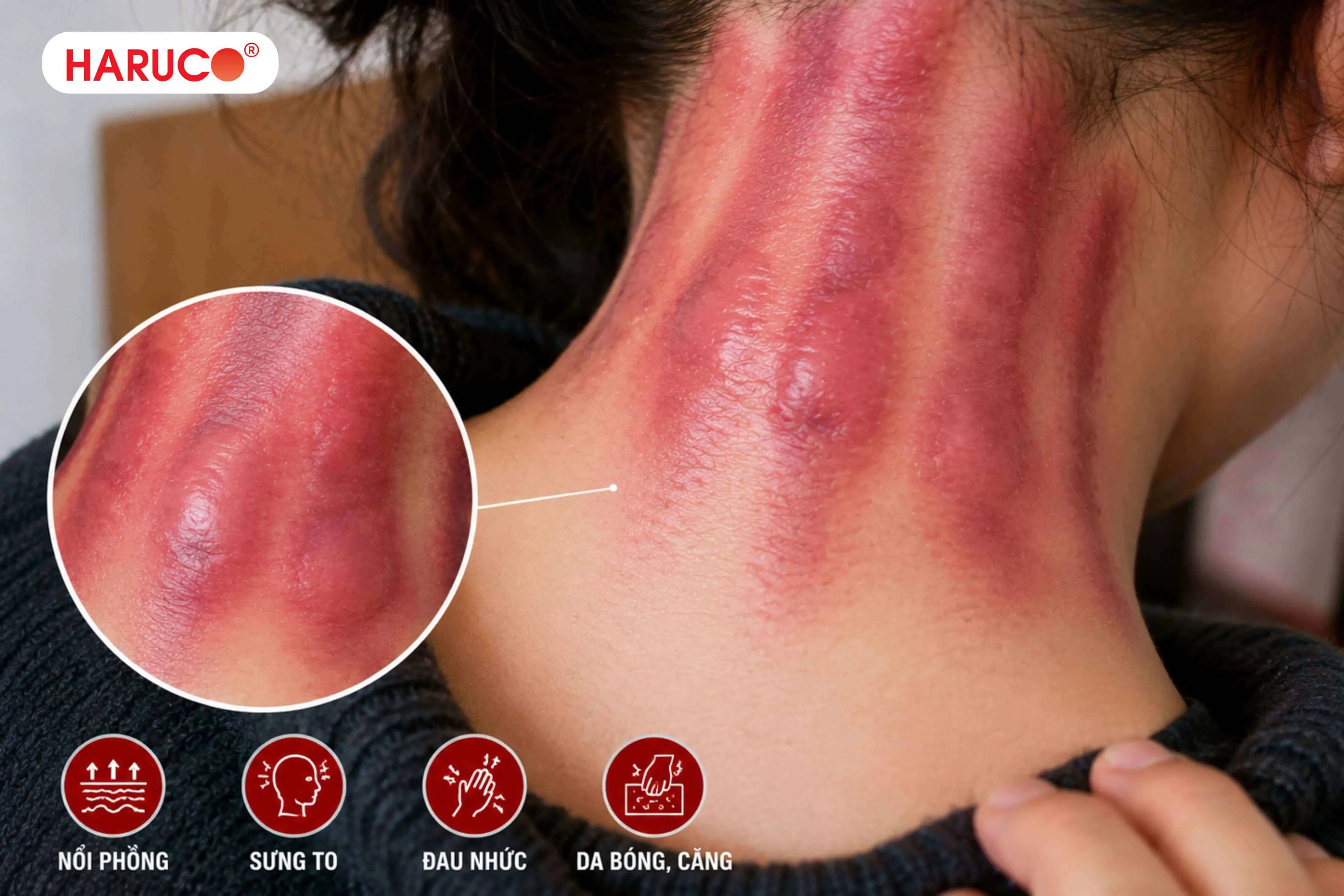 Dấu hiệu vết cạo gió là dấu hiệu bất thường cần đi khám