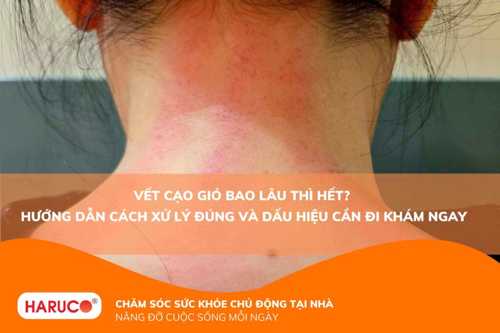 Vết cạo gió bao lâu thì hết? Hướng dẫn cách xử lý đúng và dấu hiệu cần đi khám ngay