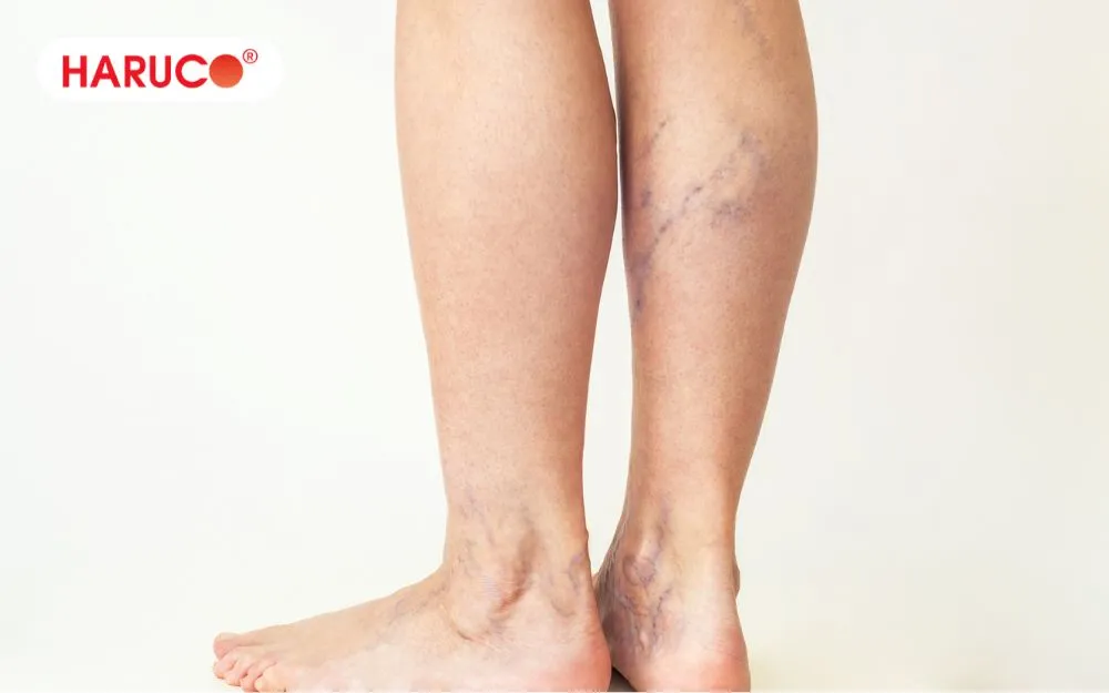 Mẹ bầu bị giãn tĩnh mạch không nên ngâm chân