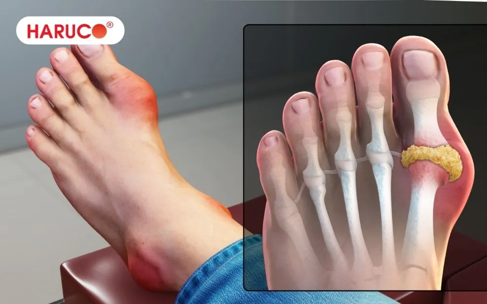 Rượu rễ cây cỏ xước góp phần hỗ trợ người bị bệnh gout ở giai đoạn nhẹ