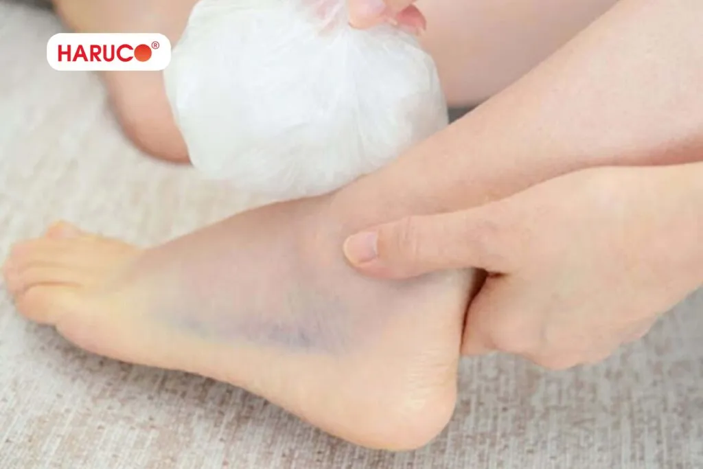 Cách chườm đá đúng cách khi bong gân