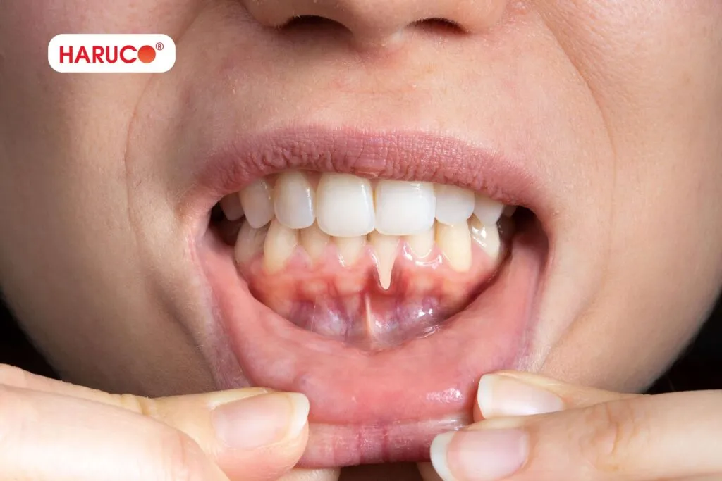 Nguyên nhân khiến lợi dễ bị tổn thương khi dùng tăm nước