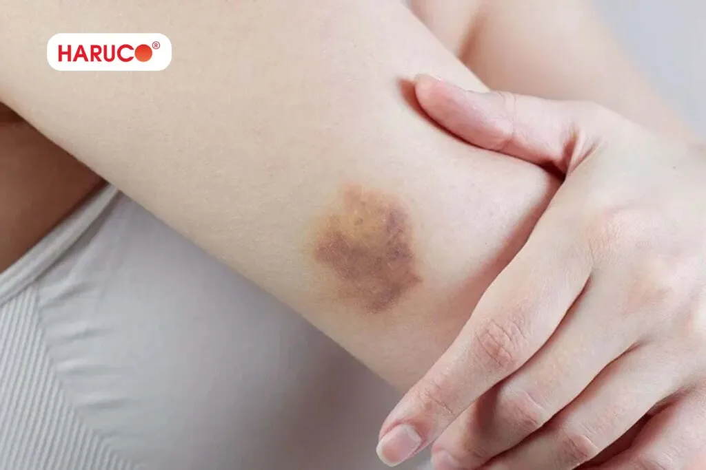 Lấy máu vỡ ven là gì?
