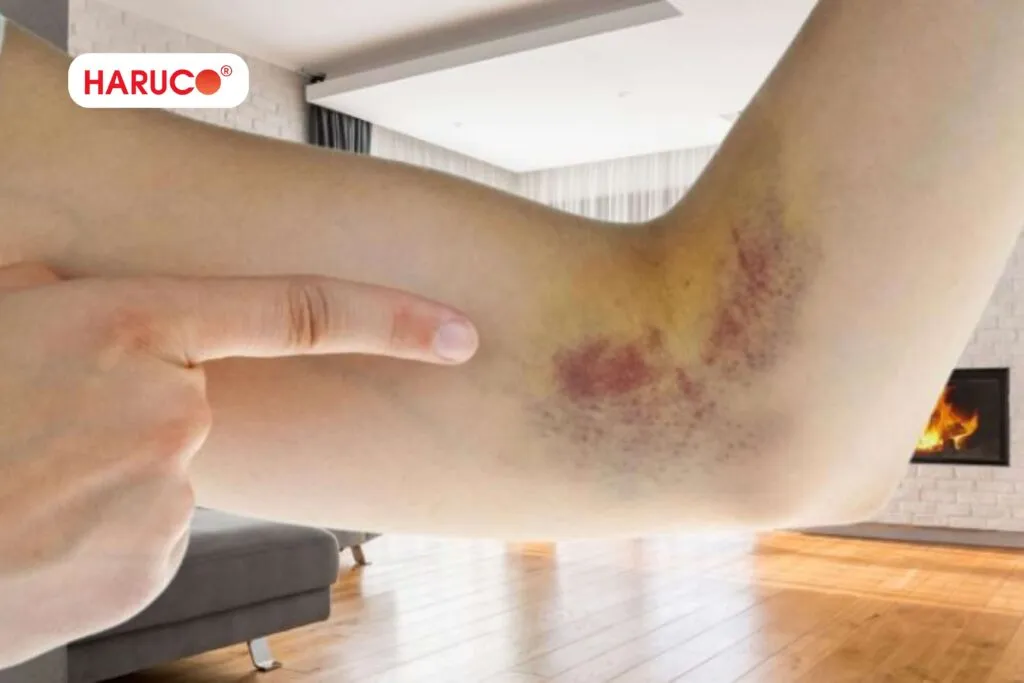 Cách xử lý đúng vỡ ven khi tiêm tại nhà