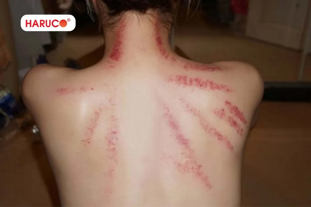 Dụng cụ cần chuẩn bị khi bị đánh gió bằng dầu gió
