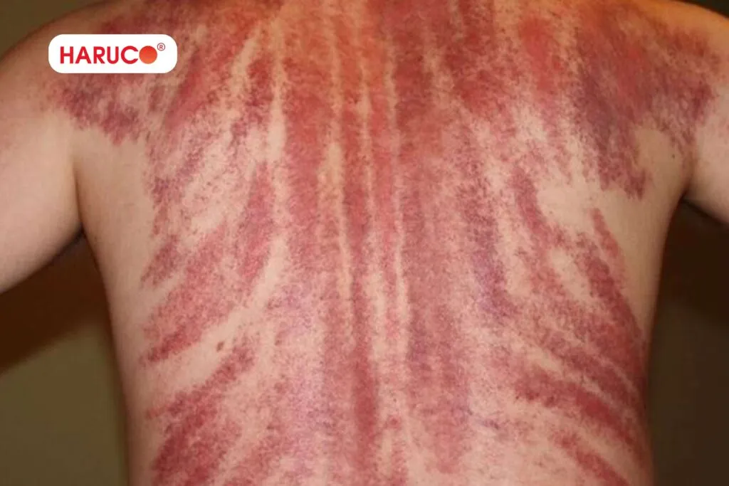 Cạo gió có tác dụng gì?