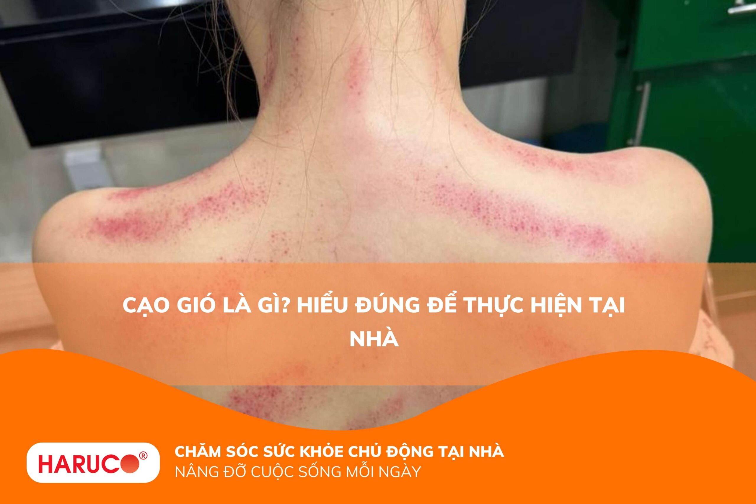 Cạo gió là gì? Hiểu đúng để thực hiện tại nhà
