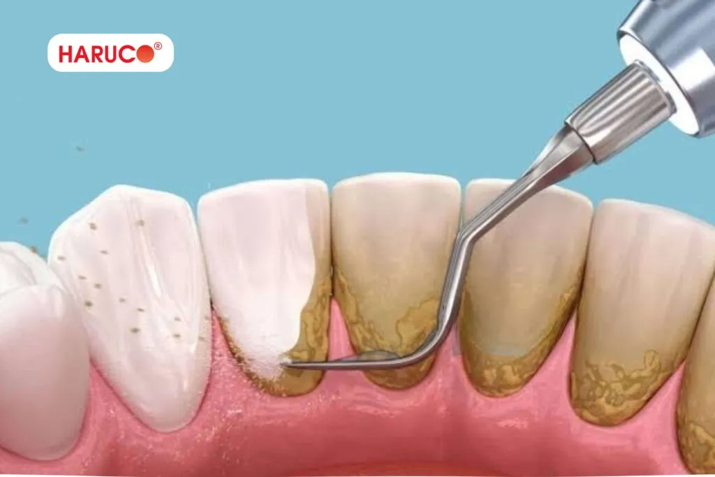 Kết hợp sử dụng lá lốt với biện pháp chăm sóc răng miệng khác
