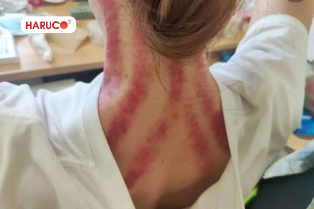 Cách cạo gió khi bị đau đầu an toàn tại nhà