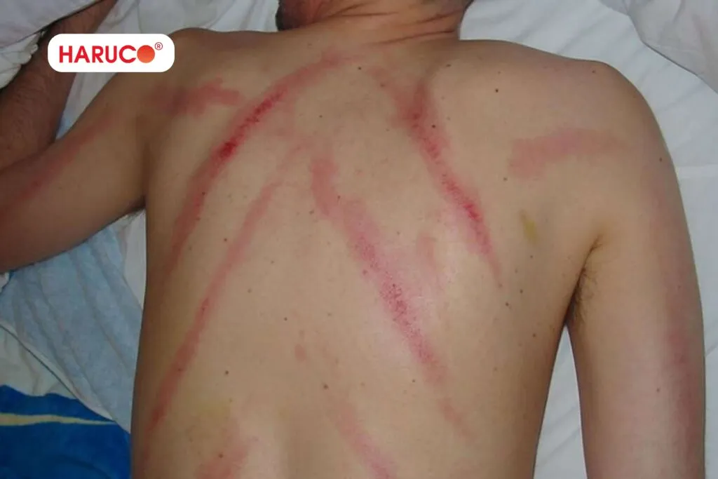 Cạo gió ở lưng có tác dụng gì?