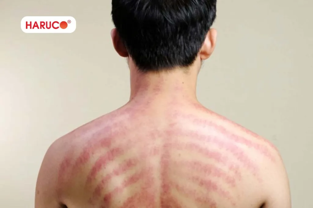 Cạo gió ở lưng có phải càng đỏ càng tốt?