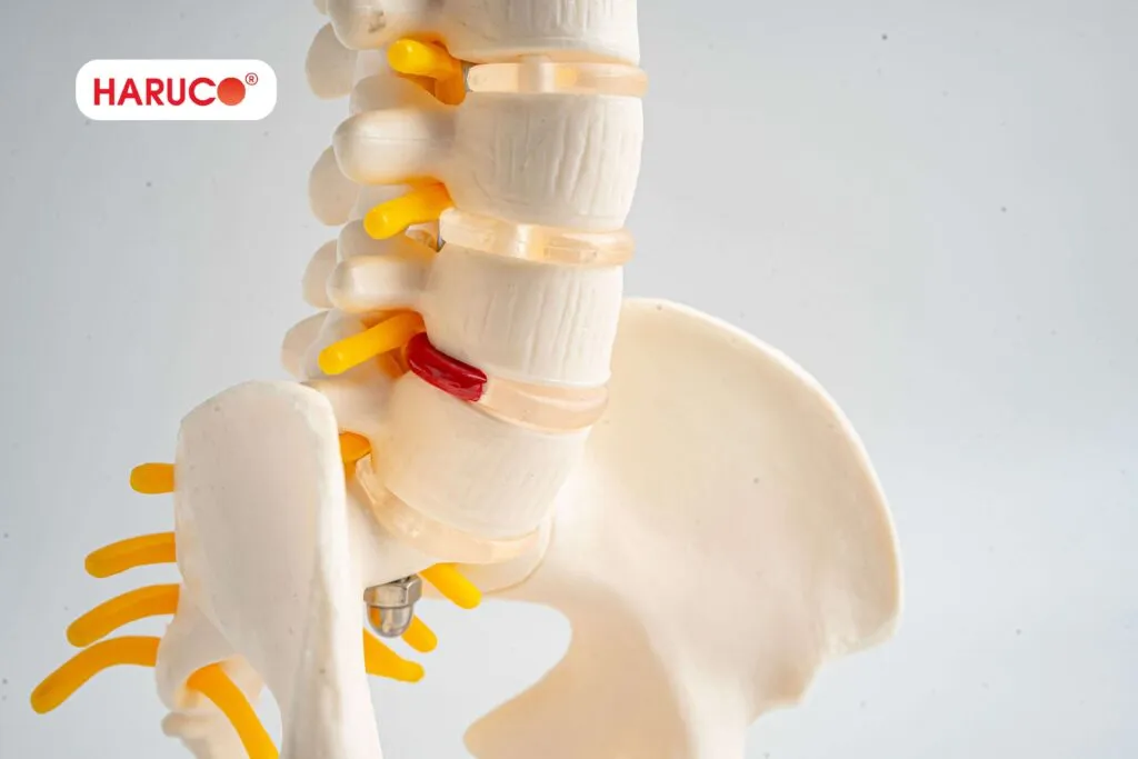 Trường hợp người bị thoát vị đĩa đệm không nên tập squat